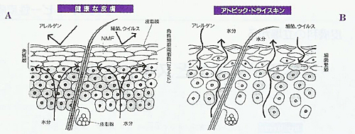 中川秀巳：アトピー性皮膚炎のスキンケアー。1997