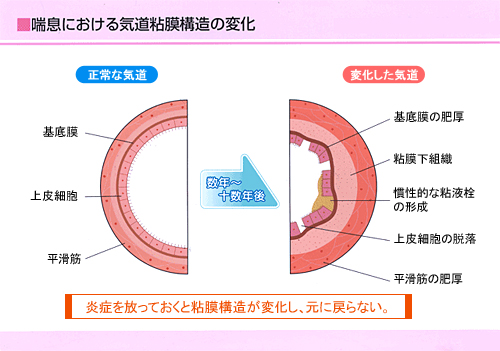 Q4.喘息の治療は具体的にどうすればいいのですか？